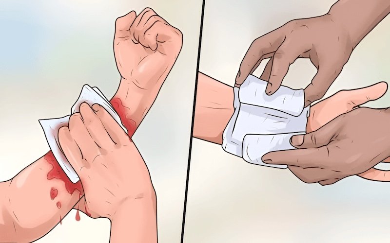 Băng bó đúng cách giúp bảo vệ vết thương khỏi bụi bẩn và vi khuẩn xâm nhập từ bên ngoài
